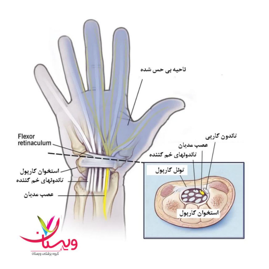 سندروم تونل کارپال سندروم تونل کارپال