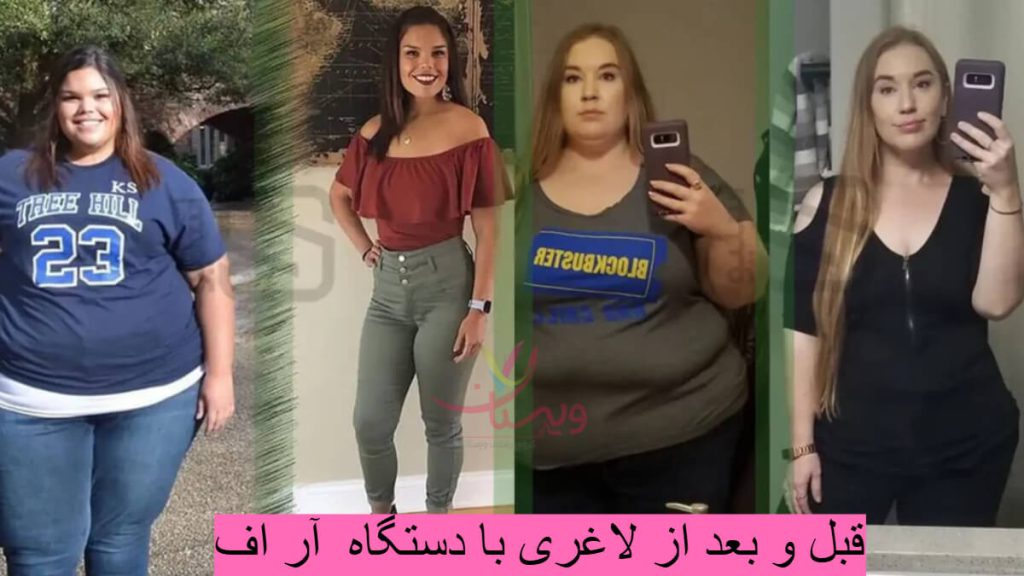 تصویر قبل و بعد از لاغری با RF دو خانم تصویر قبل و بعد از لاغری با RF دو خانم