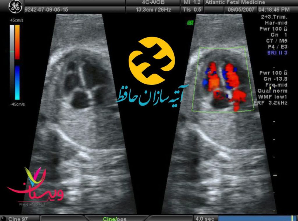 عکس اکوی قلب عکس اکوی قلب