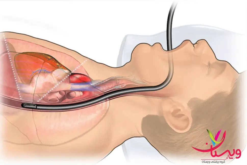 بیمار در حال انجام اکو ترانس ازوفاژیال