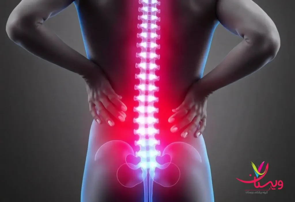 یک بیمار بار درد سیاتیک