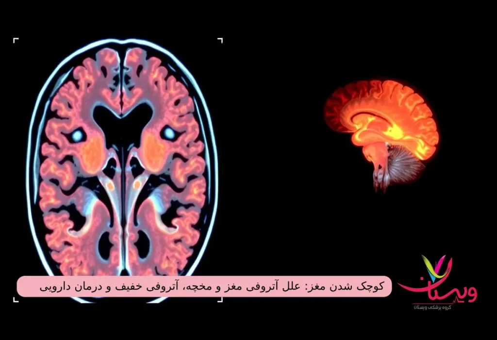 ان آر آی مغز کوچک شده