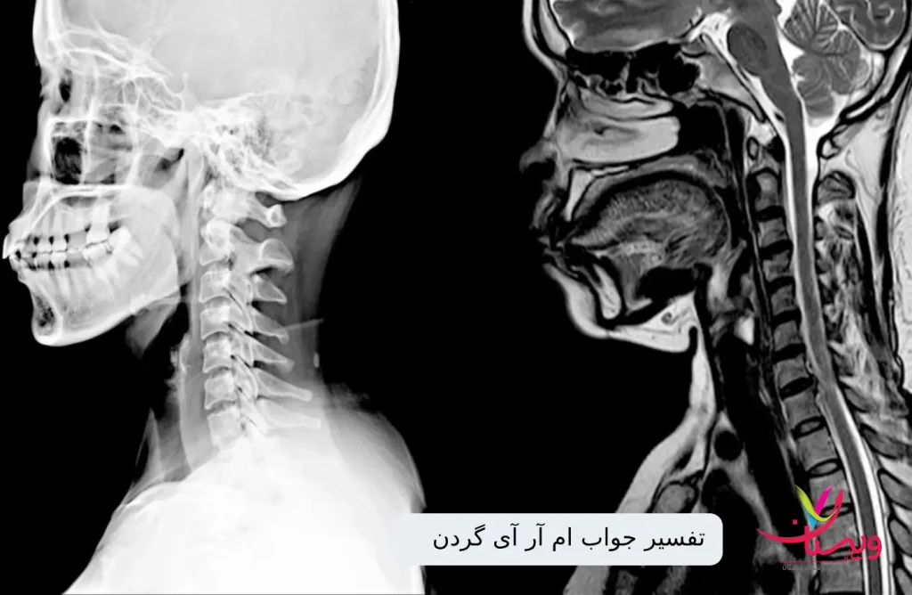 تفسیر آنلاین ام آر آی|نمونه عکس ام آر آی گردن