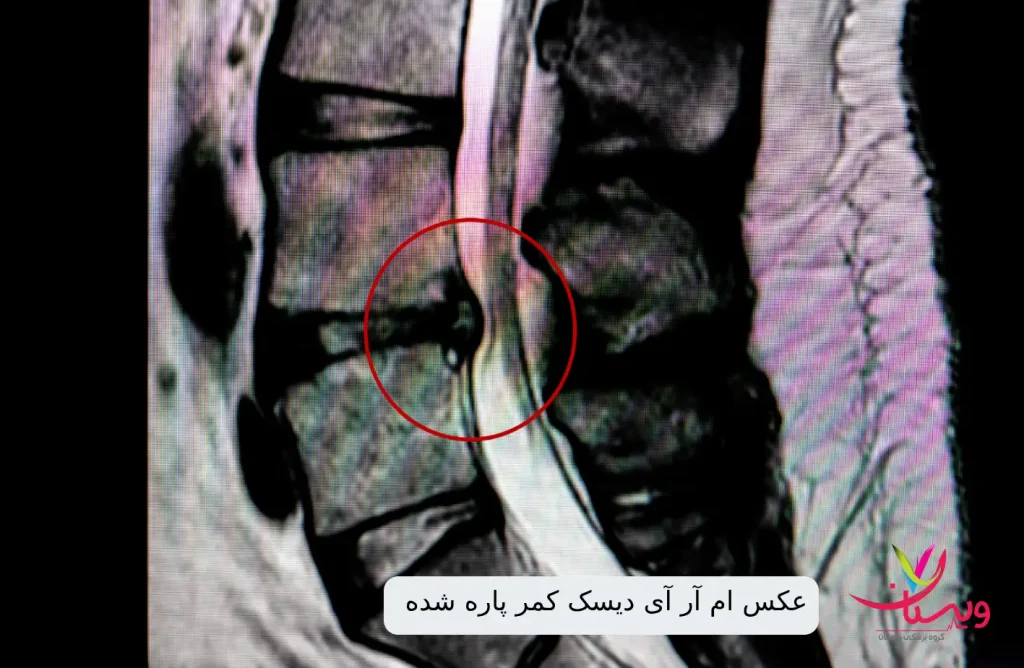 عکس ام آر آی دیسک کمر پاره شده|نمونه عکس از دیسک کمر
