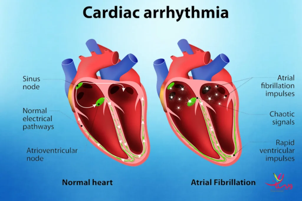 تفاوت قلب سالم قلب آریتمی