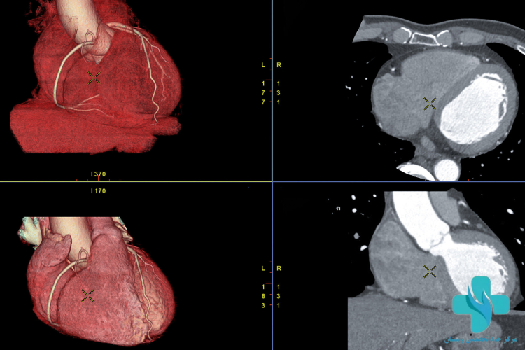 تصویر سی تی آنژیو قلب