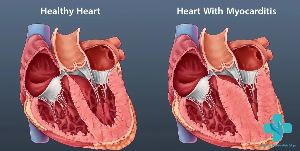 نمایی از قلب سالم و قلب با میوکاردیت