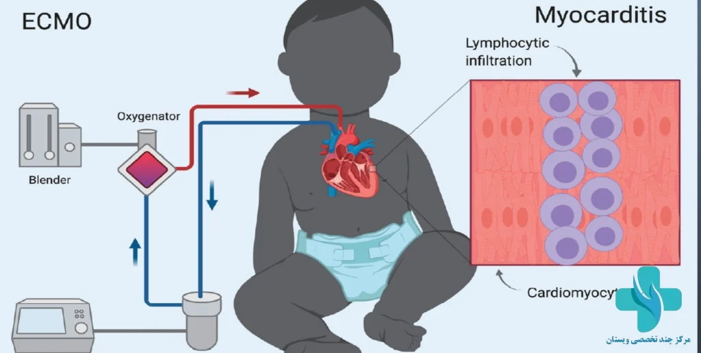 میوکاردیت قلب در کودکان