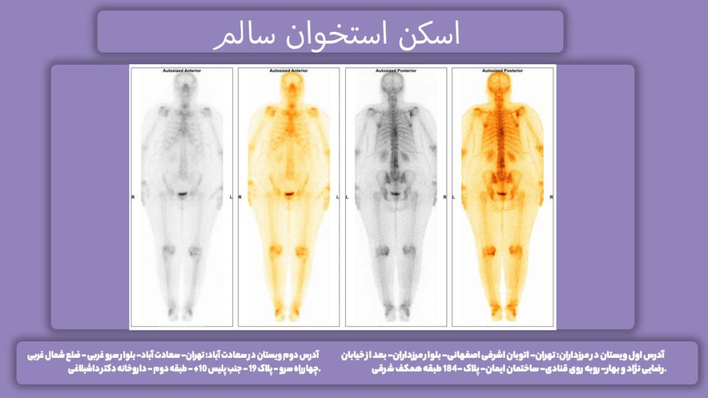 عکس از استخوان سالم اسکن استخوان سالم