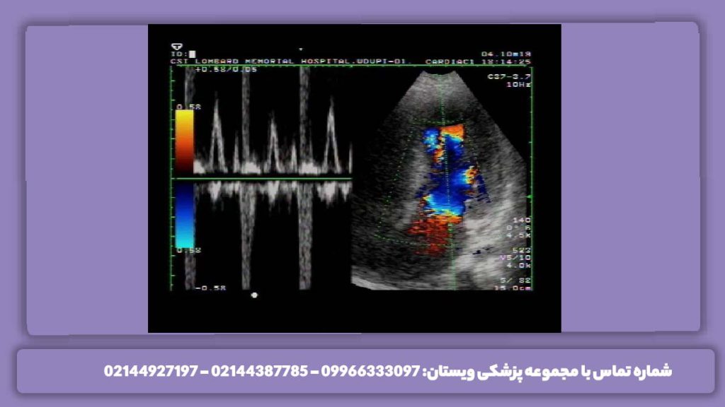 عوارض عکس رنگی قلب خطرات اکو داپلر رنگی کدام است؟