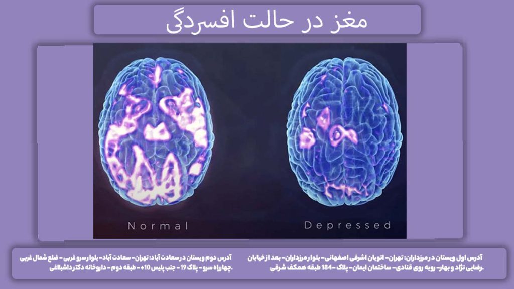عکس مغز افسرده مغز در حالت افسردگی