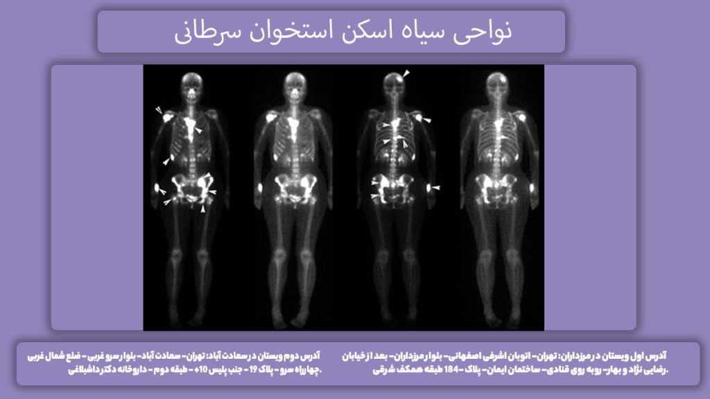 نقاط سیاه رنگ در اسکن هستهای نواحی سیاه اسکن استخوان