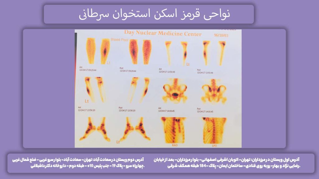 نقاط قرمز اسکن هستهای نواحی قرمز اسکن استخوان سرطانی