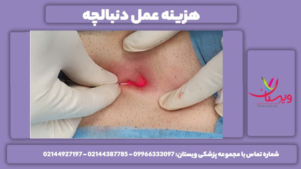 نرخ عمل جراحی هزینه عمل جراحی دنبالچه با لیزر چقدر است؟