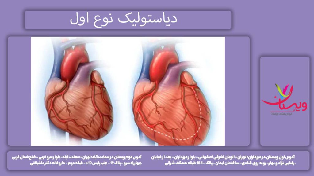 دیسفانکشن دیاستولیک گرید ۱ اختلال عملکرد دیاستولیک درجه یک چیست؟
