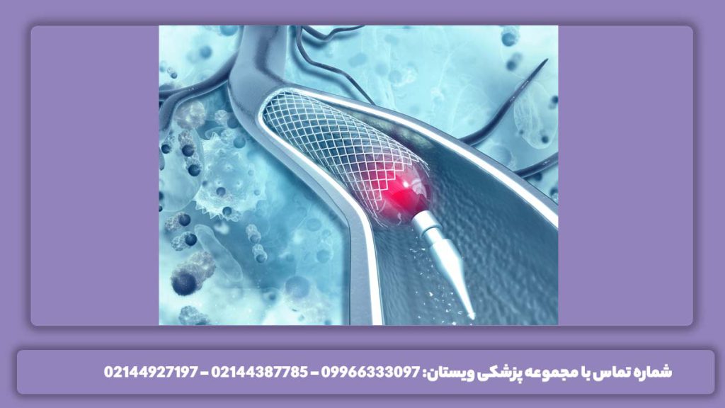 آنژیوگرافی با بیمه تامین اجتماعی هزینه در مراکز سی تی آنژیو در کرج