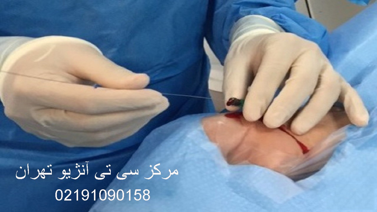 ماده تزریقی در سی تی آنژیو