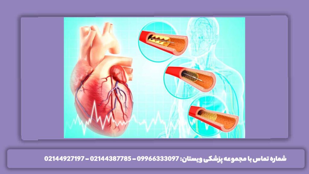 آنژیو قلب در مرکز تخصصی تهران آیا آنژیو قلب خطرناک است+ انجام در بهترین مرکز
