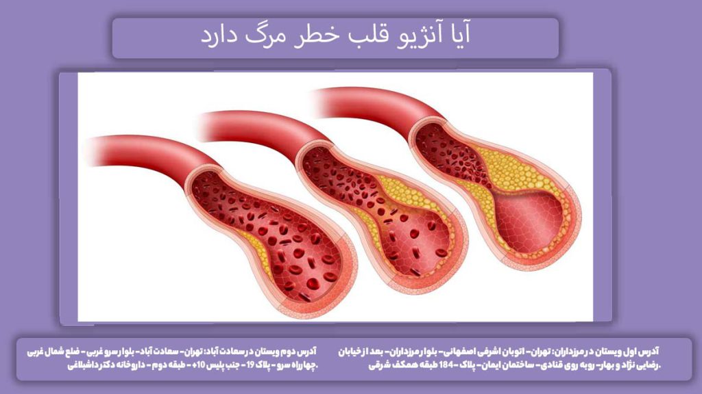 میزان مرگ و میر در اثر آنژیو آیا آنژیو قلب خطر مرگ دارد