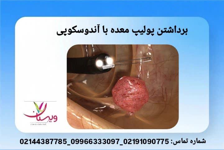 تشریح کامل روند اندوسکوپی برداشت مستقیم ضایعه معده