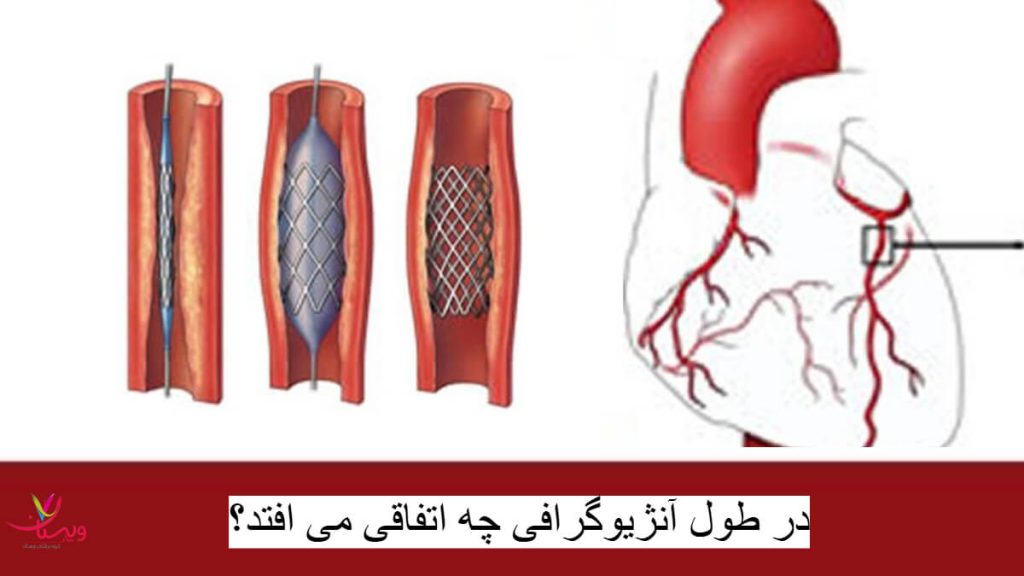در طول آنژیوگرافی چه اتفاقی می افتد؟ در طول آنژیوگرافی چه اتفاقی می افتد؟