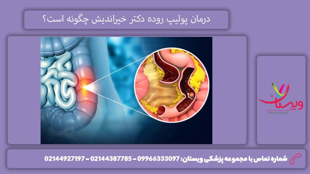 پولیپ روده با روش خیراندیش درمان پولیپ روده دکتر خیراندیش چگونه است؟