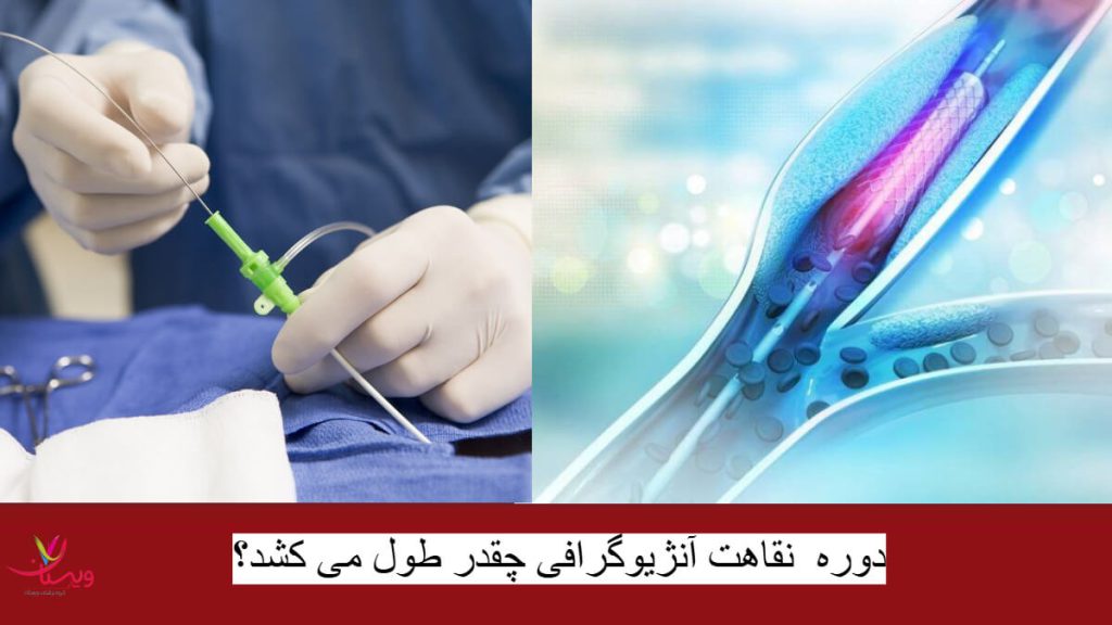 دوره نقاهت آنژیوگرافی قلب چقدر طول می کشد؟ دوره نقاهت آنژیوگرافی قلب چقدر طول می کشد؟