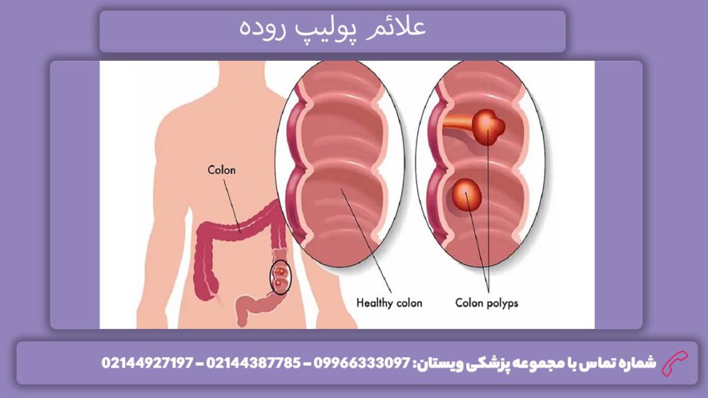 نشانههای پولیپ کولون علائم پولیپ روده خطرناک