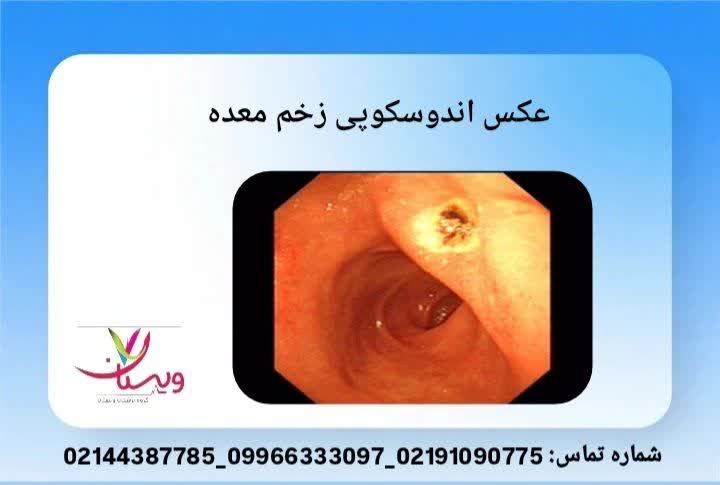 زخم معده در اندوسکوپی تخریب بافت در ناحیه دیواره معده
