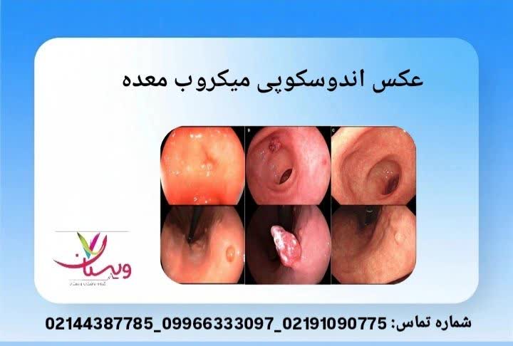 عکس آندوسکوپی میکروب معده