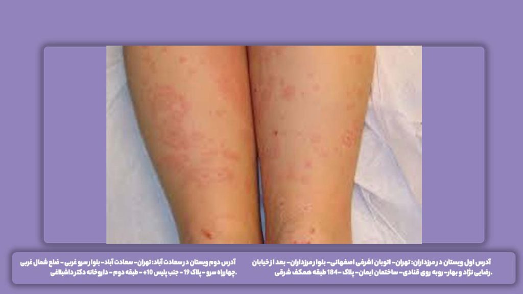 بیماری التهابی قلب عکس روماتیسم قلبی