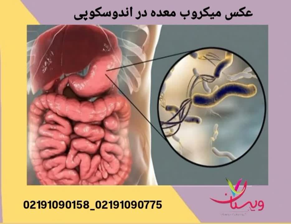 نمای آندوسکوپی از حضور میکروب عامل عفونت معده در دیواره داخلی آن عکس میکروب معده در اندوسکوپی