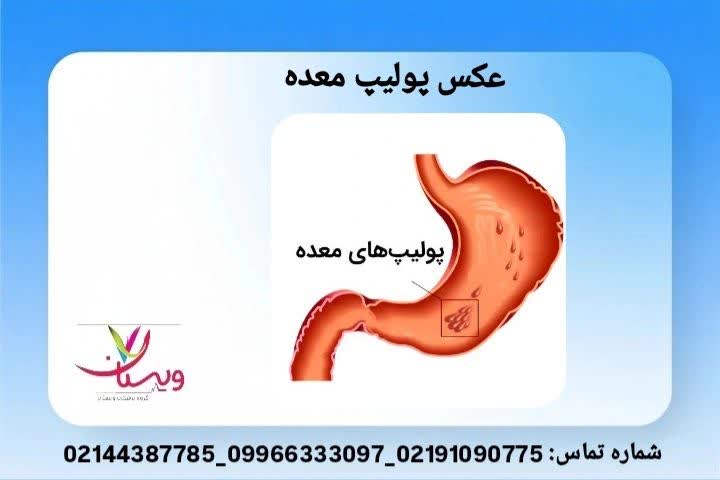 مجموعه عکسهای آندوسکوپی از انواع پولیپ معده برای شناخت دقیق توسط بیماران و پزشکان تصاویر داخلی معده