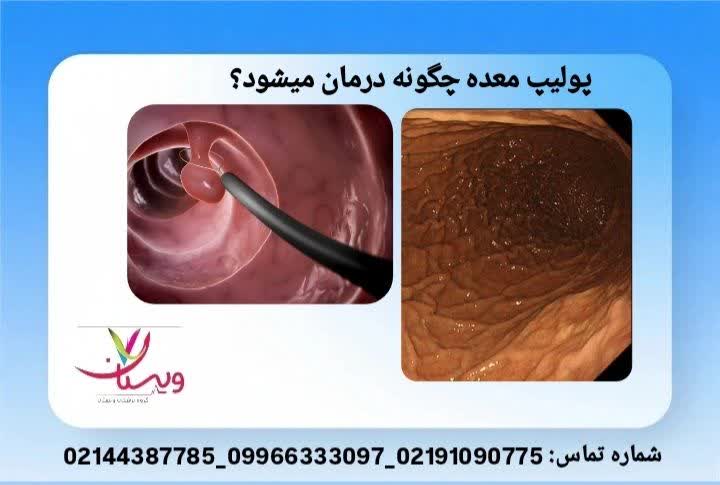 دارو، رژیم و آندوسکوپی آیا پولیپ معده همان سرطان است