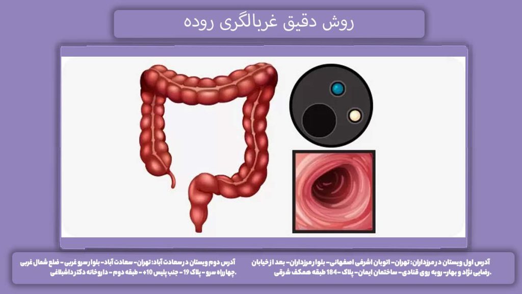 روش دقیق غربالگری روده دقیق ترین روش غربالگری سرطان روده بزرگ