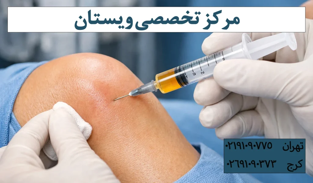 prp زانو