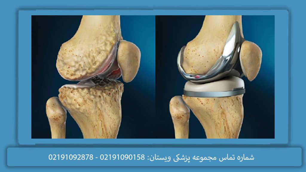 svf زانو ویژگی تزریق svf زانو