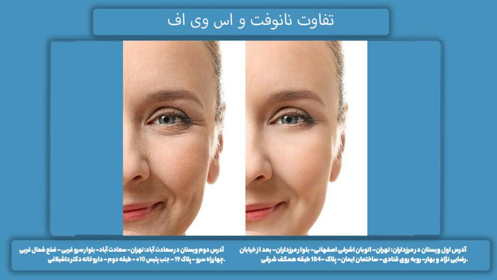 احیای مفصل زانو با تکنیک SVF و نانوفت تفاوت نانوفت و اس وی اف