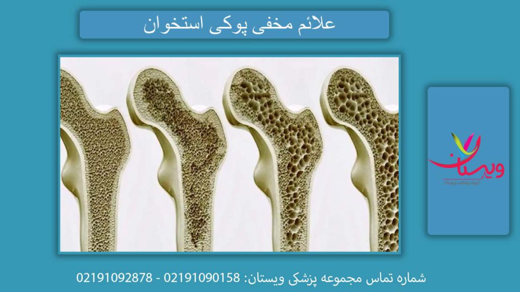 نشانههای پنهان تراکم استخوان علائم تراکم استخوان چیست؟ بررسی علائم مخفی
