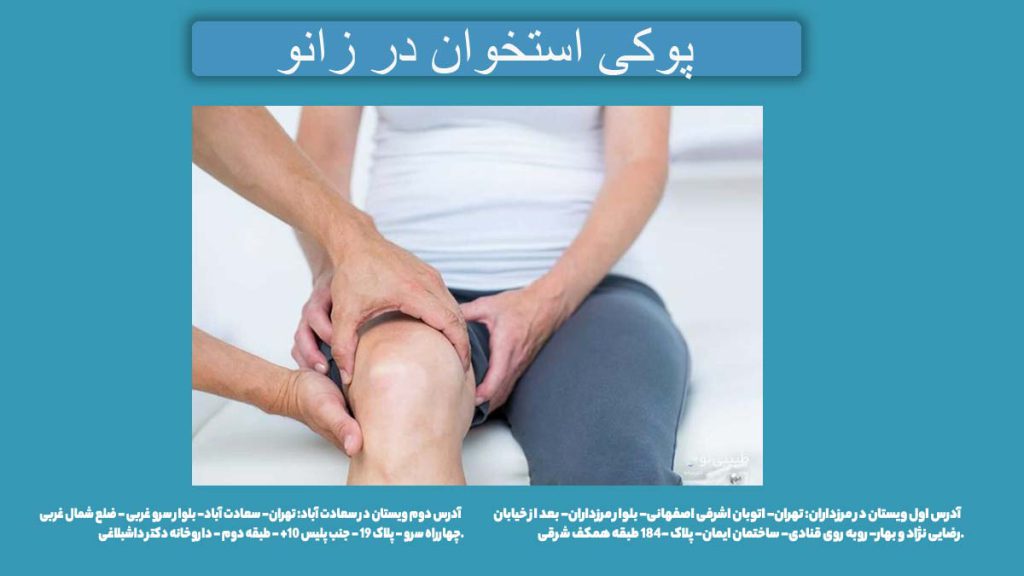 پوکی استخوان در زانو نشانههای پوکی استخوان در زانو