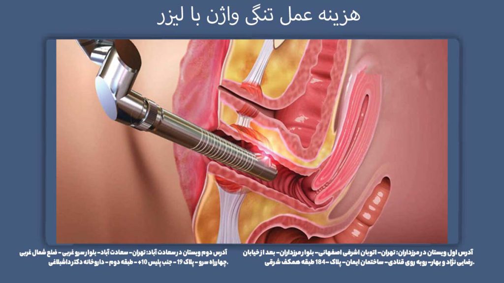 قیمت واژینال پلاستی هزینه عمل تنگی واژن با لیزر