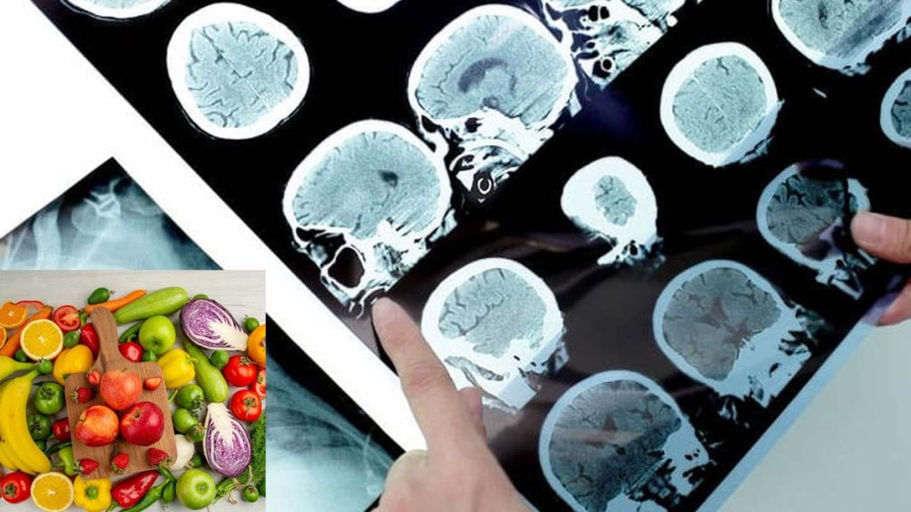غذای بعد از پت اسکن بعد از پت اسکن چه بخوریم