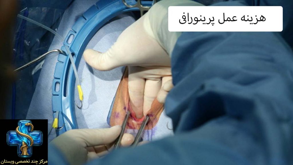 هزینه عمل پرینورافی