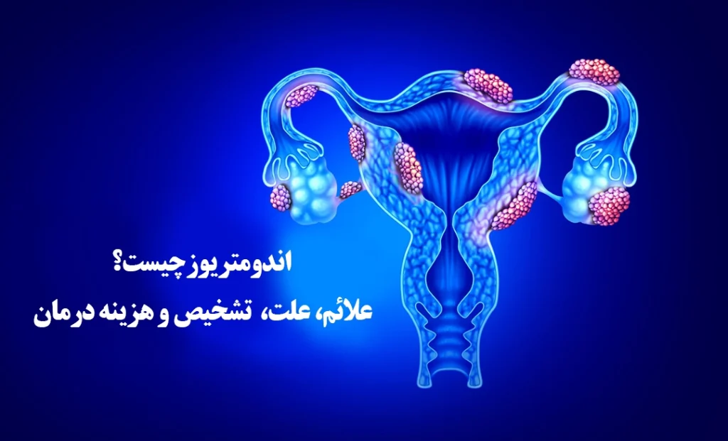 اندومتریوز چیست؟ علائم، تشخیص، هزینه درمان 1405