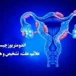 اندومتریوز چیست؟ علائم، تشخیص، هزینه درمان 1405