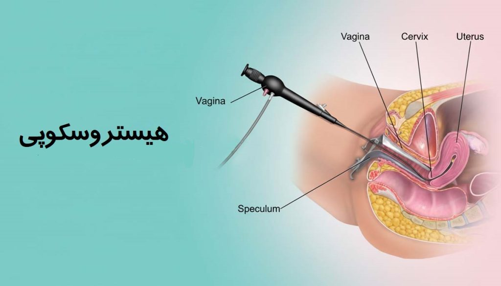 هزینه هیستروسکوپی با بیمه تامین اجتماعی
